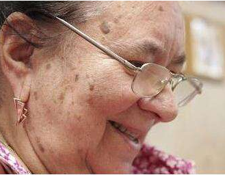 老年斑的形成原因