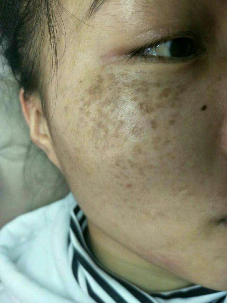 日常简单有效的祛斑方法有那些？