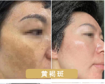 素颜黄褐斑肌肤_养_护_修